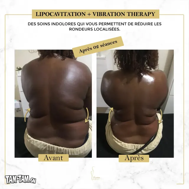 Affinez Votre Silhouette Sans Chirurgie