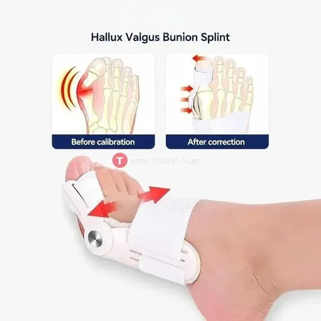 Attelle pour hallux valgus, Correcteur du gros orteil